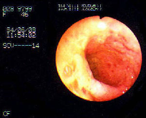 鍼灸治療開始時の潰瘍性大腸炎の大腸カメラ像