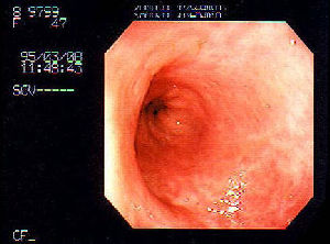 数年にわたる鍼灸治療で緩解状態にある潰瘍性大腸炎の大腸カメラ像