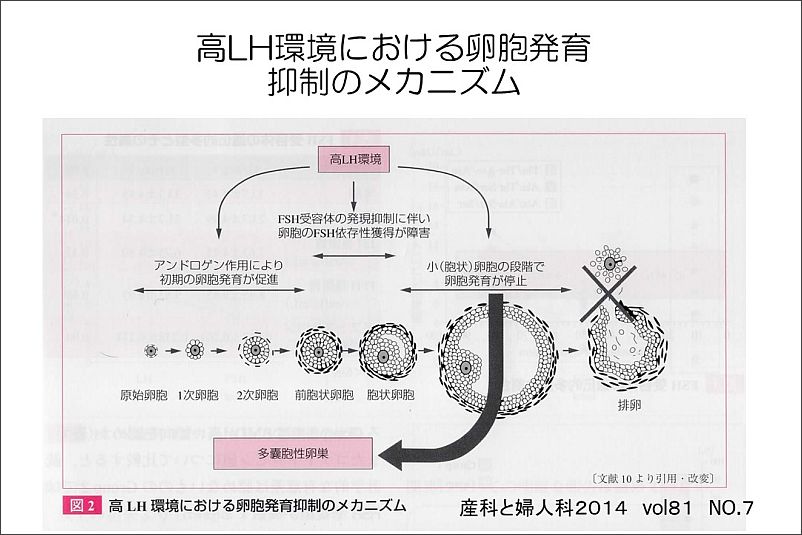PCO（多嚢胞性卵巣）症候群への鍼灸の対応 | 三瓶鍼療院 歳時記（ブログ）